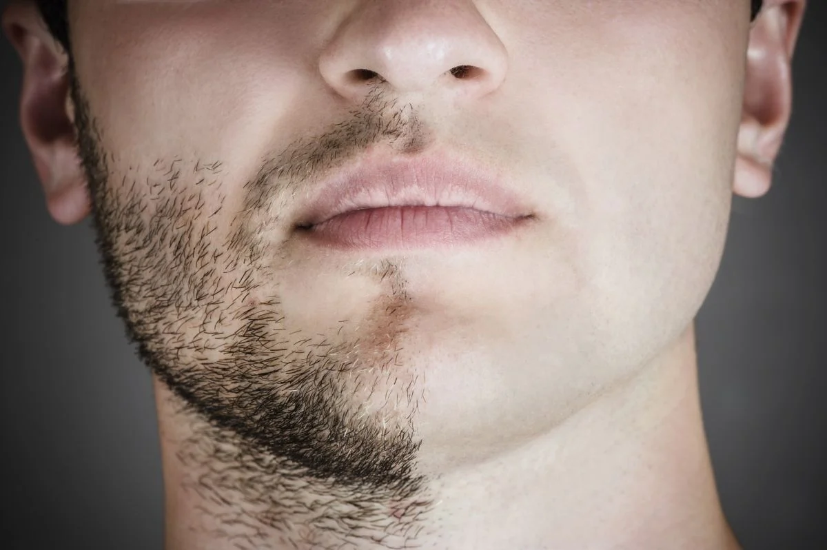 Laser Hair Removal Men - Health360 Faisalabad Laser Hair Removal Men - Health360 Faisalabad