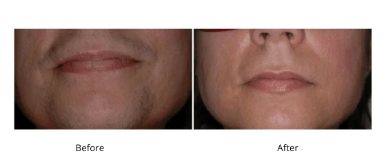 Laser Hair Removal Men - Health360 Faisalabad Add-a-subheading-1.png