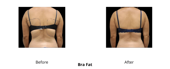 Body Contouring - Health360 Faisalabad Add-a-subheading-12.png