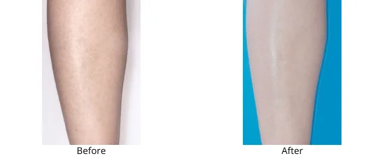 Laser Hair Removal Men - Health360 Faisalabad Add-a-subheading.png
