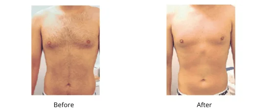 Laser Hair Removal Men - Health360 Faisalabad Add-a-subheading-4.png