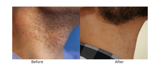 Laser Hair Removal Men - Health360 Faisalabad Add-a-subheading-6.png