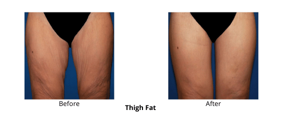 Body Contouring - Health360 Faisalabad Add-a-subheading-9.png