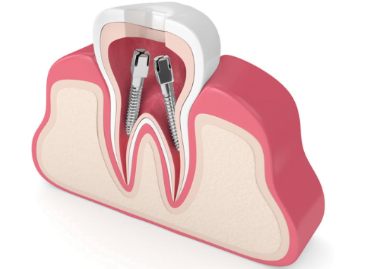 Root Canal Dental Services at Health360