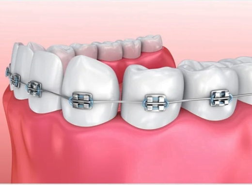 Braces Dental Services at Health360