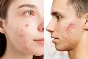 Acne treatment at Health360