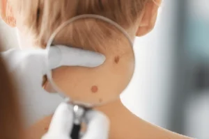Birth mark dermatology care