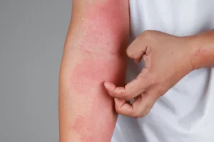 Contact dermatitis treatment