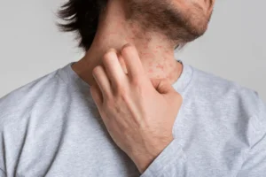Eczema treatment at Health360