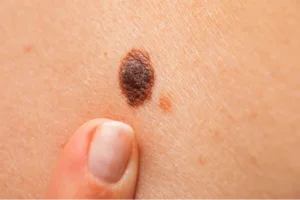 Melanoma skin concern