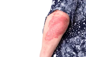 Psoriasis dermatology care