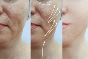 Wrinkle treatment at Health360