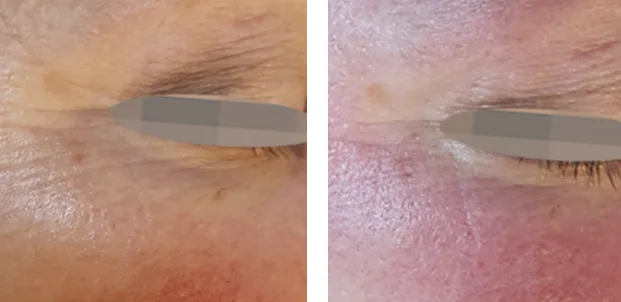 OxyGeneO Facial - Health360 Faisalabad OxyGeneO Facial - Health360 Faisalabad