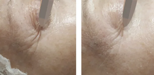 OxyGeneO Facial - Health360 Faisalabad OxyGeneO Facial - Health360 Faisalabad