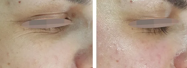 OxyGeneO Facial - Health360 Faisalabad OxyGeneO Facial - Health360 Faisalabad