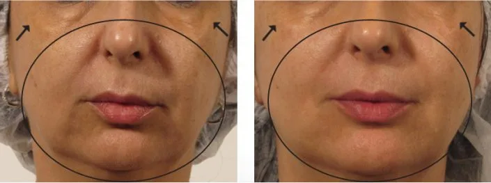 OxyGeneO Facial - Health360 Faisalabad OxyGeneO Facial - Health360 Faisalabad