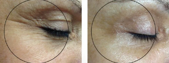 OxyGeneO Facial - Health360 Faisalabad OxyGeneO Facial - Health360 Faisalabad
