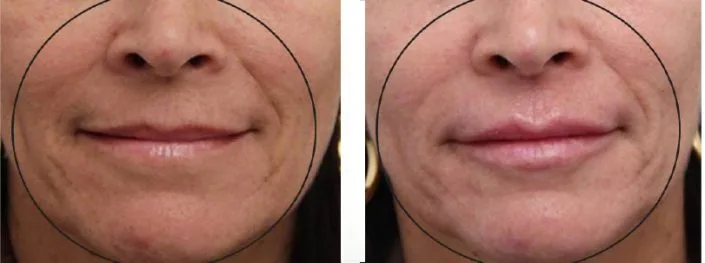 OxyGeneO Facial - Health360 Faisalabad OxyGeneO Facial - Health360 Faisalabad