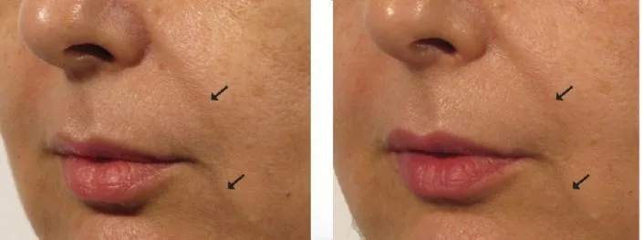OxyGeneO Facial - Health360 Faisalabad OxyGeneO Facial - Health360 Faisalabad