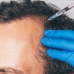 Hair PRP