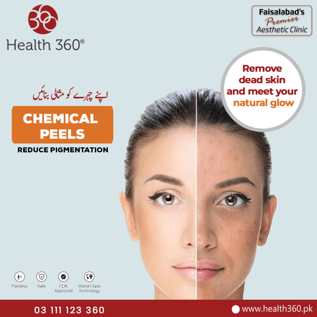 Transforming Skin with Chemical Peels - Health360 Faisalabad Transforming Skin with Chemical Peels