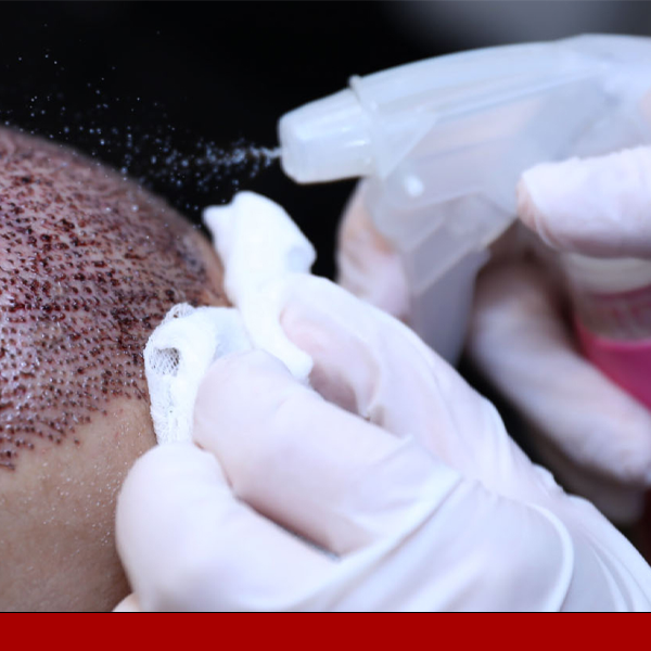 Get the Best Hair Transplant Solution at Halth360 Hair Clinic in Faisalabad - Health360 Faisalabad Get the Best Hair Transplant Solution at Halth360 Hair Clinic in Faisalabad