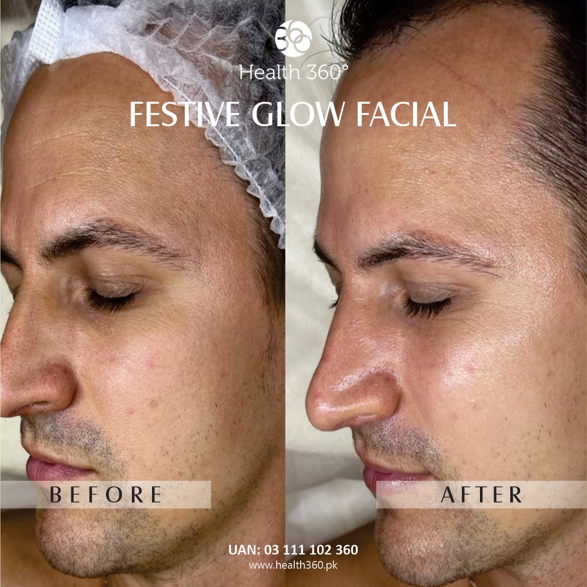 Festive Glow Facial for Male (Before and After Results) - Best facial for male instant glow in Faisalabad, Rawalpindi, Islamabad, Pakistan