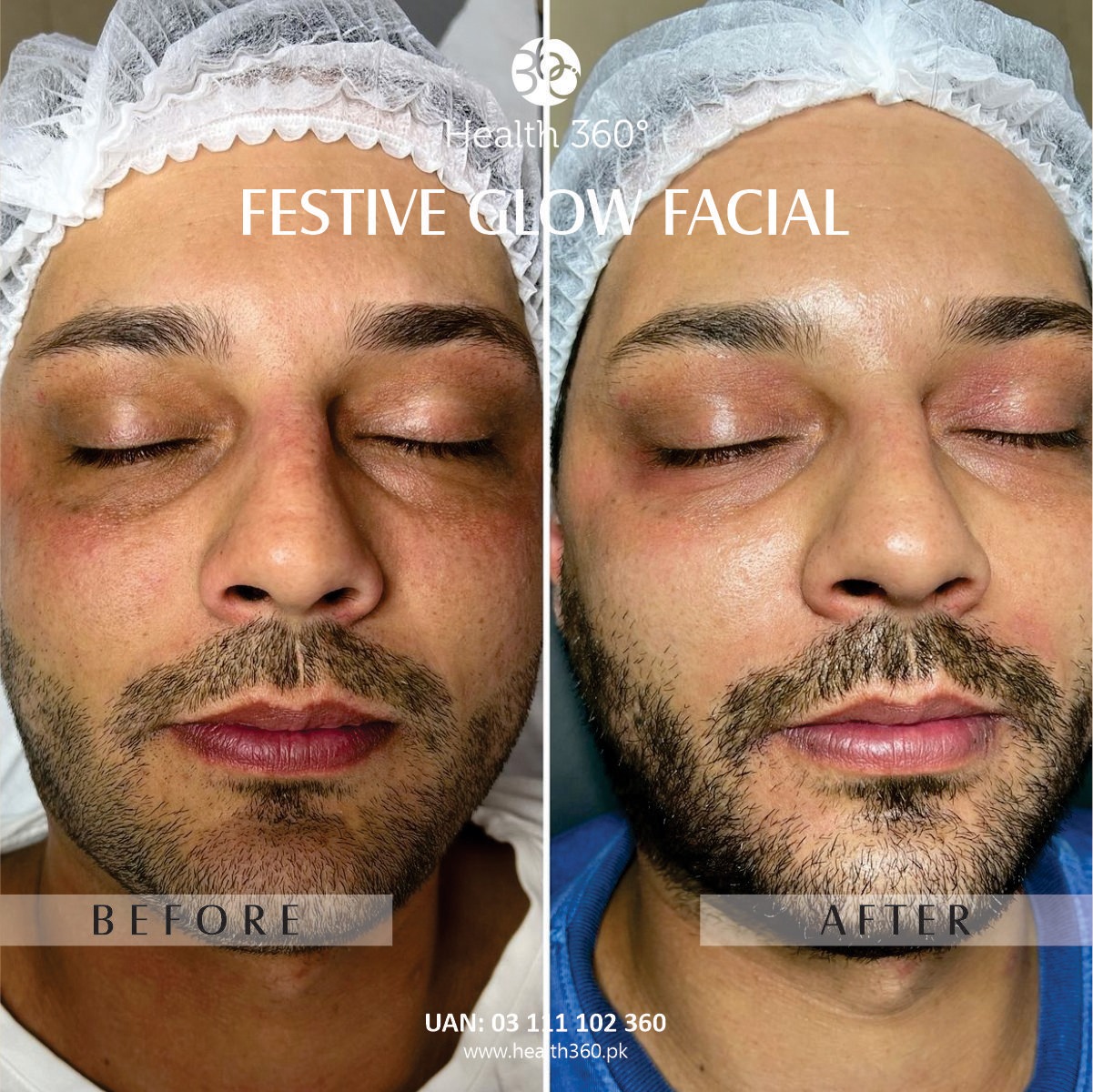 Festive Glow Facial for Male (Before and After Results Pakistan) - Best facial for male instant glow in Faisalabad, Rawalpindi, Islamabad, Pakistan