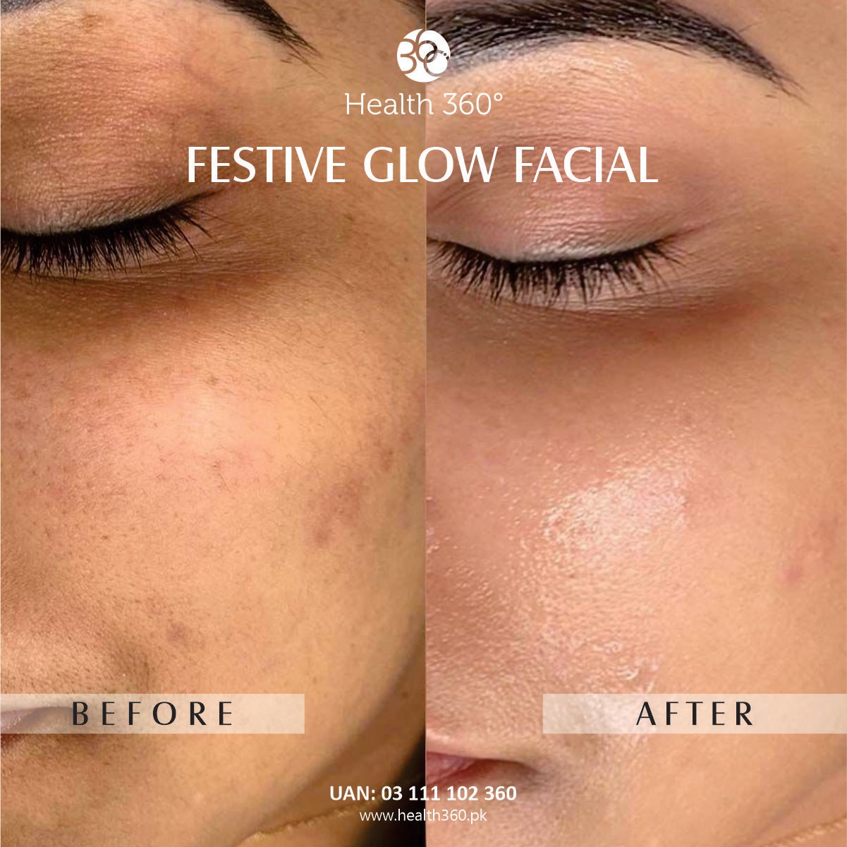 Festive Glow Facial Female (Before and After Results) - Best facial for male instant glow in Faisalabad, Rawalpindi, Islamabad, Pakistan