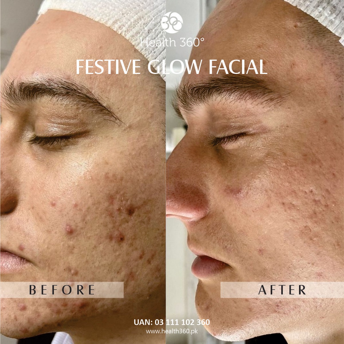 Festive Glow Facial Male (Before and After Results) - Best facial for male instant glow in Pakistan (Faisalabad, Rawalpindi, Islamabad)