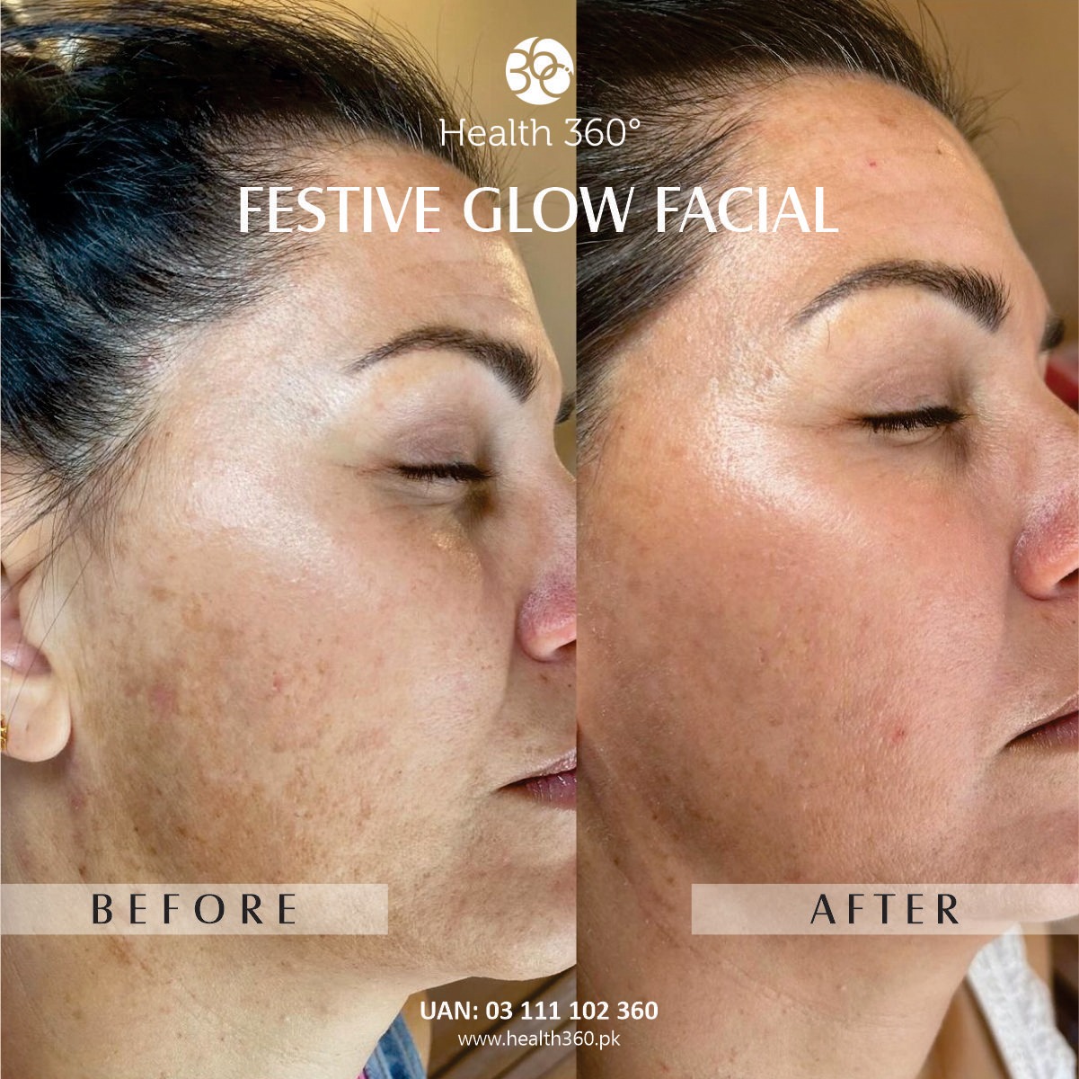 Festive Glow Facial Woman (Before and After Results) - Best facial before special occasions in Faisalabad, Rawalpindi, Islamabad
