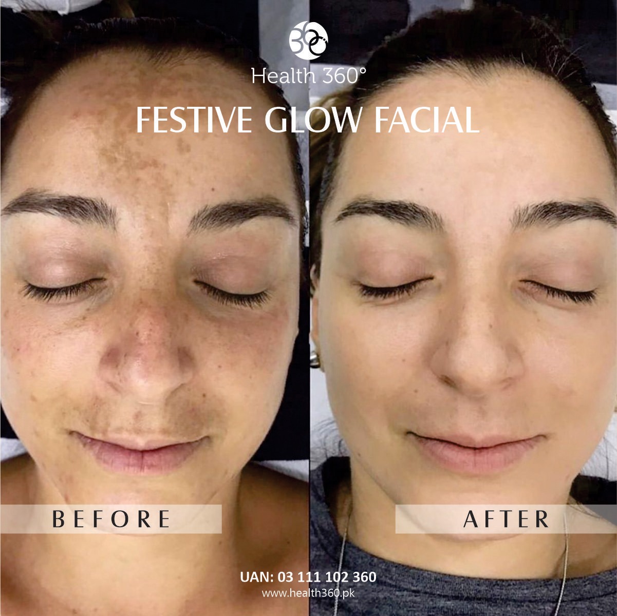 Health360 Festive Glow Facial Female Pakistan - Before and After Results